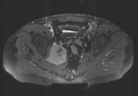 define melanotic stool What Causes Black or Tarry Stool?