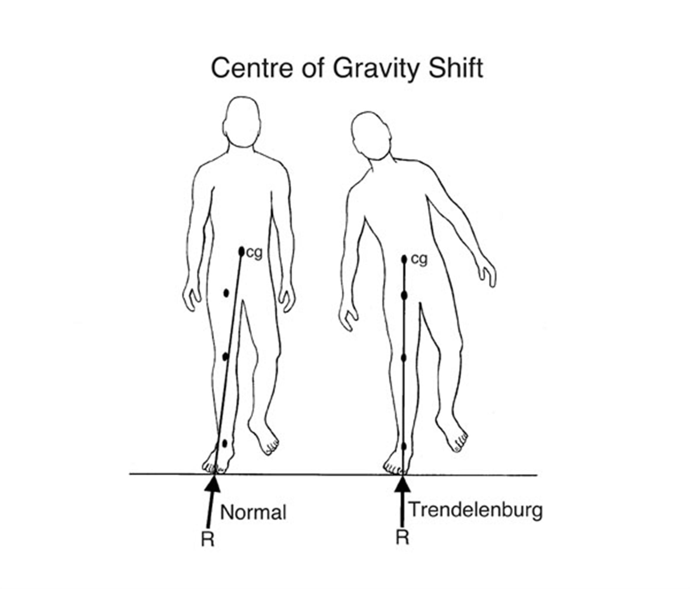 Trendelenburg Sign Hip
