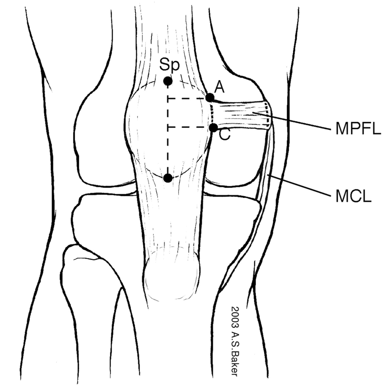 Mpfl Patellofemoral Medial Ligament Orthobullets Knee Tear 